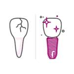 Zahnimplantat - Zahnarzt für Zahnimplantate