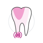 Caries penetrans Gesunde Zähne Vorsorge und Behandlung der Karies